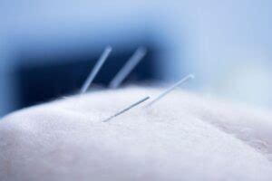 beati acupuncture|albany acupuncture clinic.